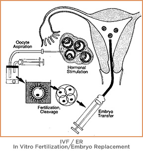 Embryo placement showing the transfer of the embryo from the lab dish into the uterus | RSC New Jersey