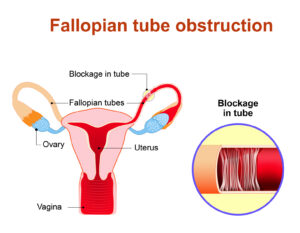 Fallopian tube obstruction or Blocked fallopian tubes. A major cause of female infertility. Uterus and uterine tubes. Human anatomy. female reproductive system. Vector diagram.