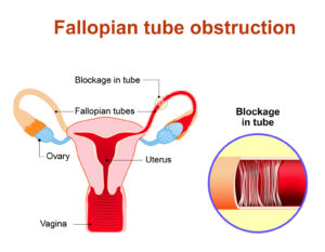 How to Remove Menstrual Clots and Restore Fertility